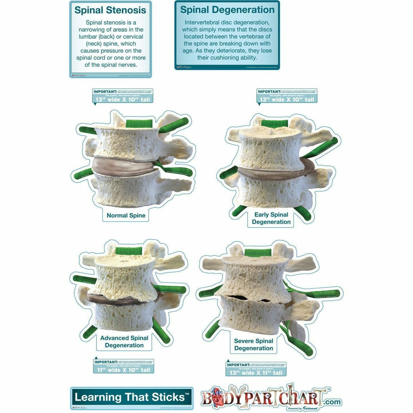 Spinal Degeneration - Labeled Removable Wall Graphic Spinal Degeneration - Labeled Removable Wall Graphic