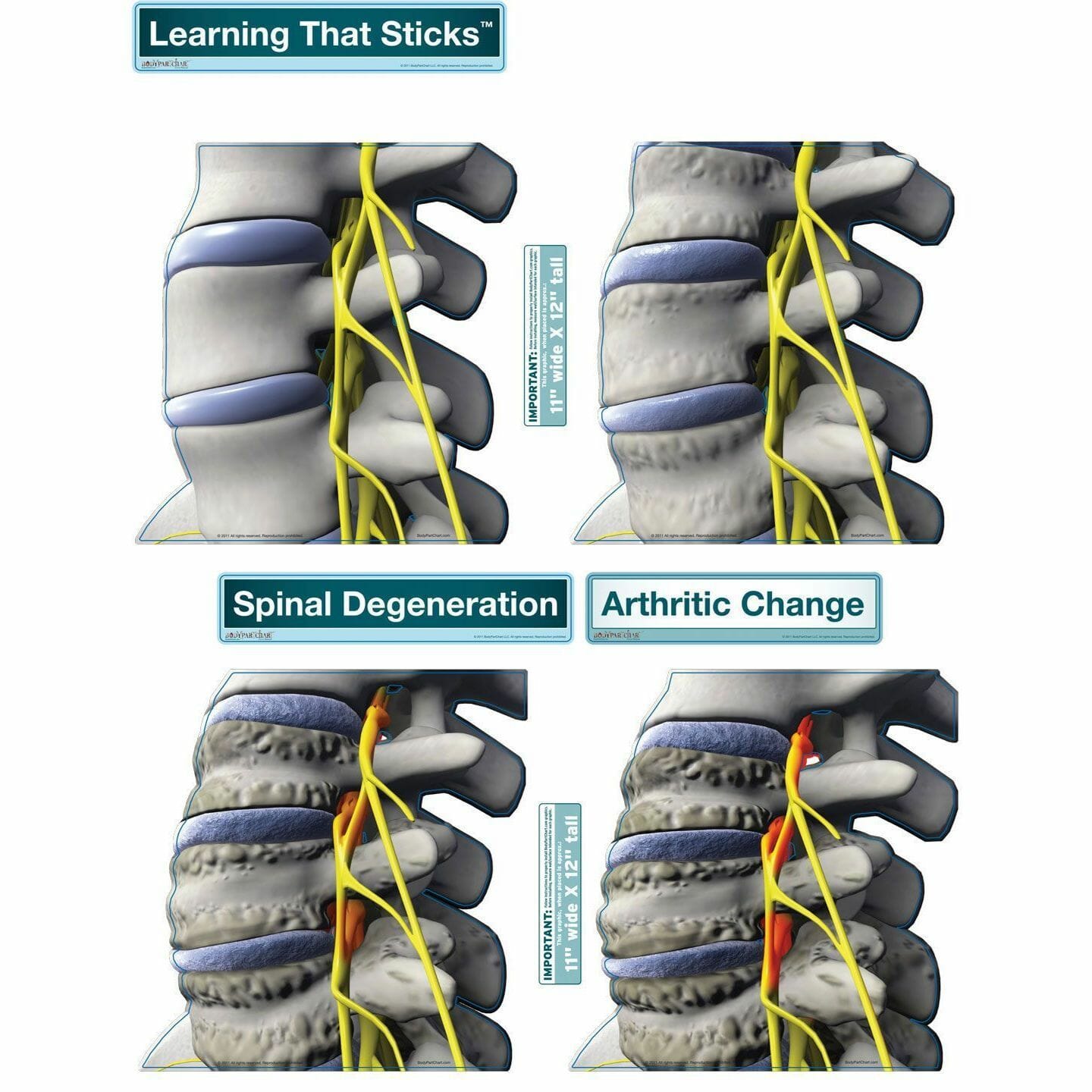 Spinal Degeneration Series - Removable Wall Graphic Spinal Degeneration Series - Removable Wall Graphic