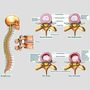 Intervertebral Disc Injuries - Removable Wall Graphic