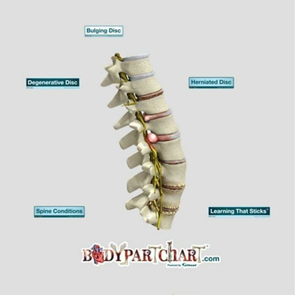 Spine Conditions - Removable Wall Graphic Spine Conditions - Removable Wall Graphic