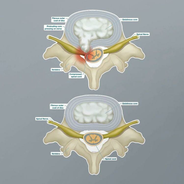 Prolapsed Disc - Labeled Removable Wall Graphic Prolapsed Disc - Labeled Removable Wall Graphic