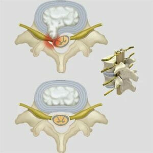 Prolapsed Disc - Removable Wall Graphics