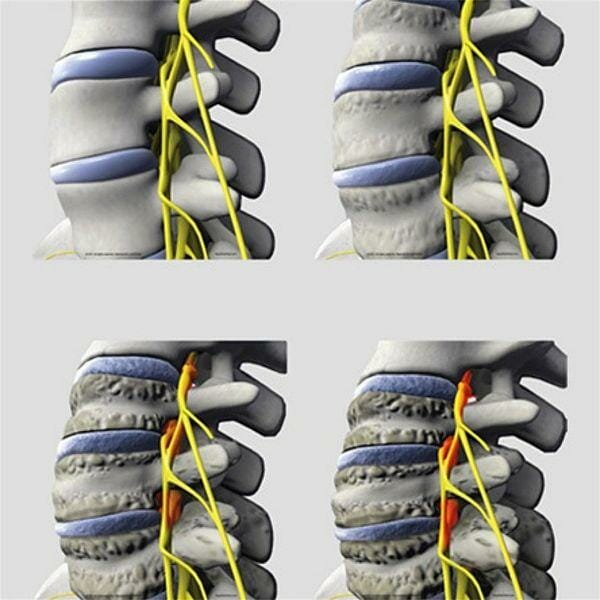 Spinal Degeneration Series - Removable Wall Graphic Spinal Degeneration Series - Removable Wall Graphic