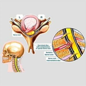 Disc Herniation Impingement - Labeled Removable Wall Graphic