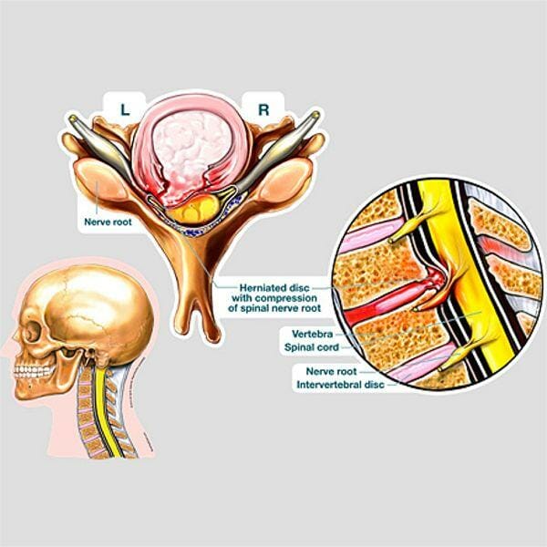 Disc Herniation Impingement - Labeled Removable Wall Graphic Disc Herniation Impingement - Labeled Removable Wall Graphic