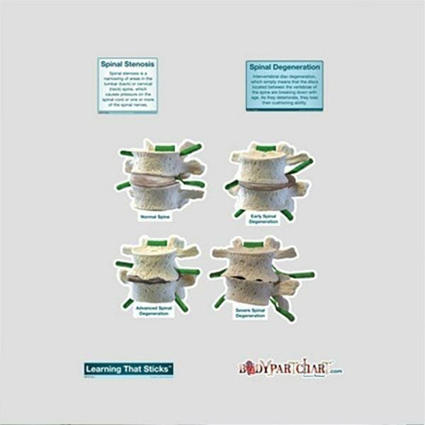 Spinal Degeneration - Labeled Removable Wall Graphic Spinal Degeneration - Labeled Removable Wall Graphic