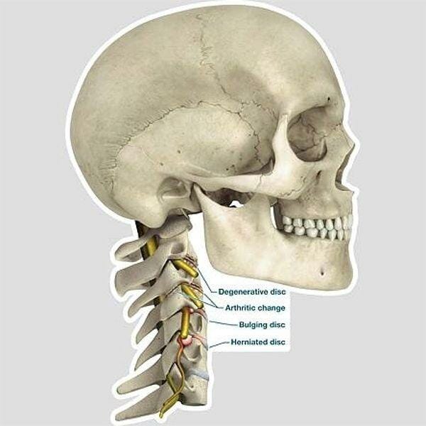 Lateral Cervical Spine Conditions - Labeled Removable Wall Graphic Lateral Cervical Spine Conditions - Labeled Removable Wall Graphic