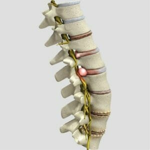 Spine Conditions - Removable Wall Graphic